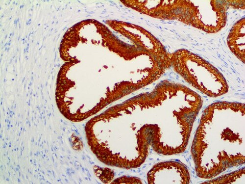 IHC of Prostate-Specific Antigen on an FFPE Prostatic Adenocarcinoma Tissue